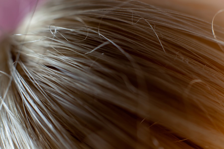 Photo Hair transplant